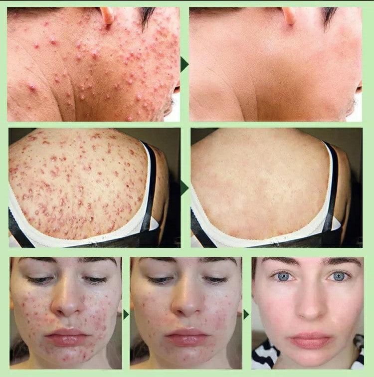 Creme Removedor de Espinhas™ - Limpeza Profunda Perfect Face