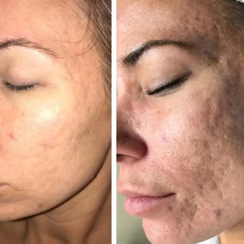 DermaWand® Pro Mesoterapia (Compre e Ganhe 1 Bolsa De Brinde)