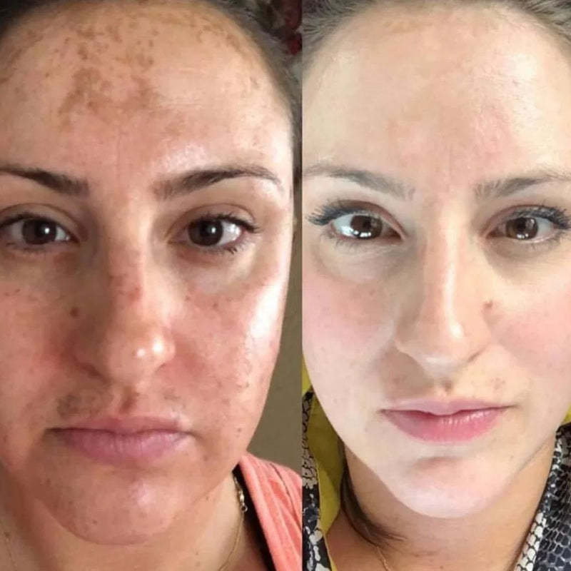 DermaWand® Pro Mesoterapia (Compre e Ganhe 1 Bolsa De Brinde)