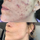 DermaWand® Pro Mesoterapia (Compre e Ganhe 1 Bolsa De Brinde)